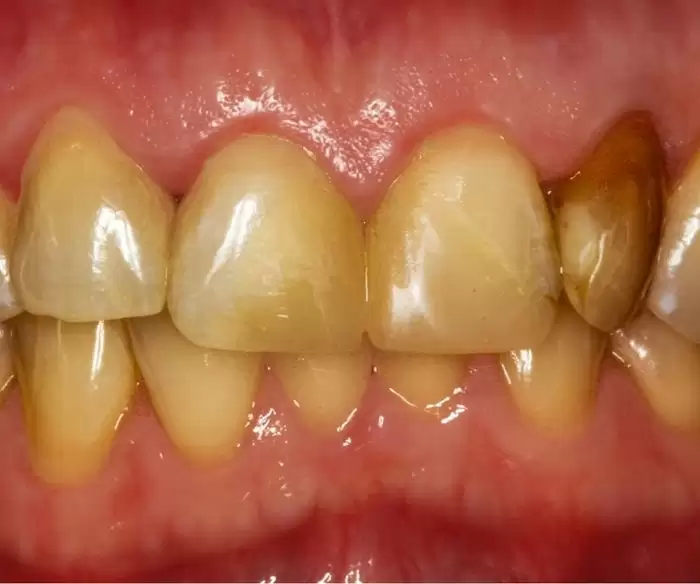 Dental Treatment Before After